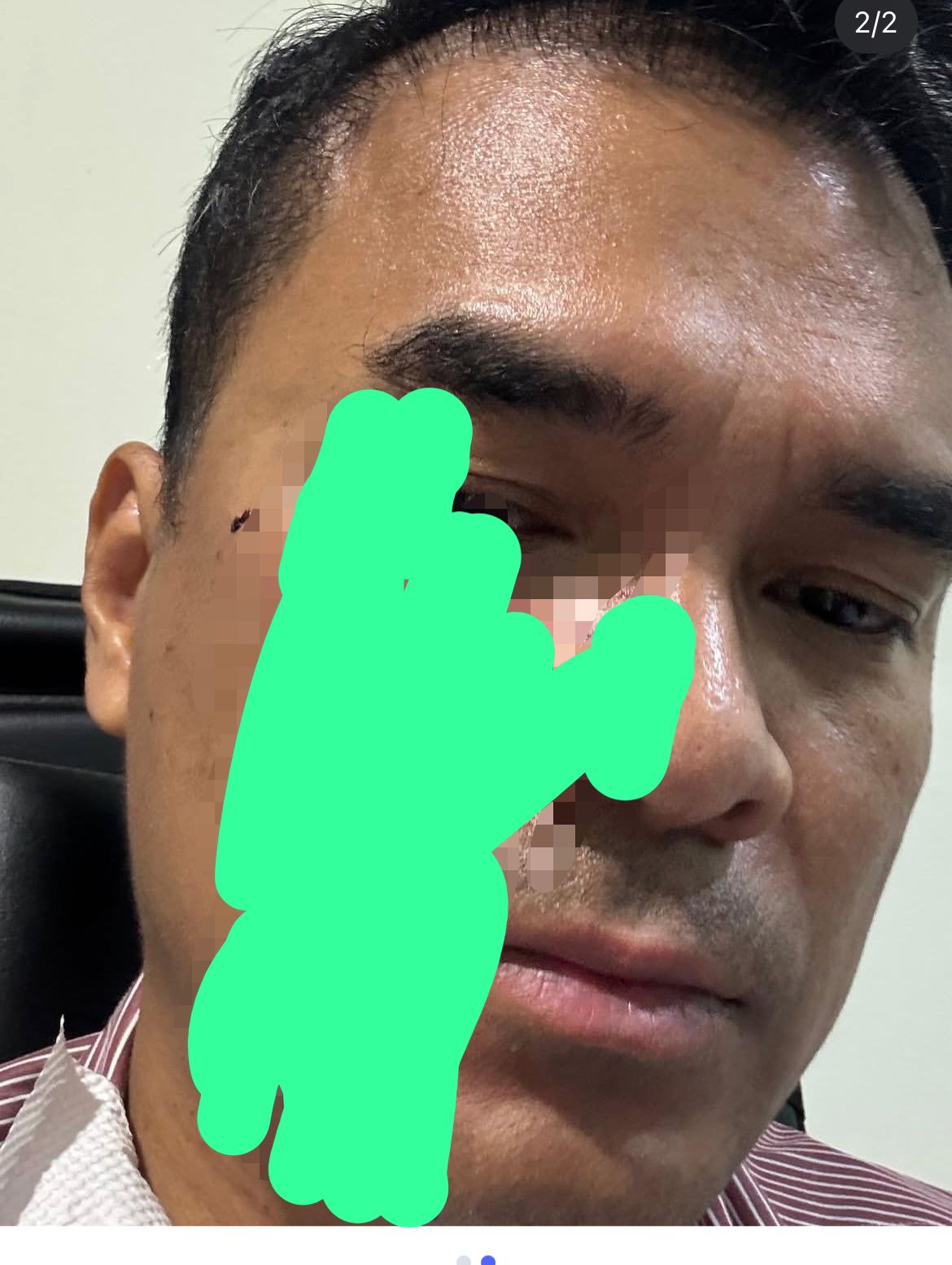 Bro ron alami pemukulan saat mendampingi karyawan PT SKS menagih hak mereka terkait dugaan penggelapan success fee di kantor MPP, kawasan Menteng, Jakarta Pusat, Foto/Istimewa